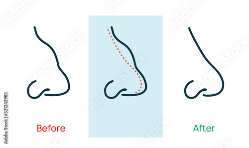 Rhinoplasty nose plastic surgey icon. Vector rhinoplasty beauty icon
