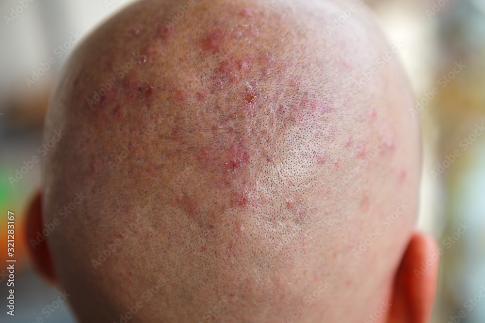 Man's shaved head with diseased skin, acne and eczema Stock Photo Adobe Stock