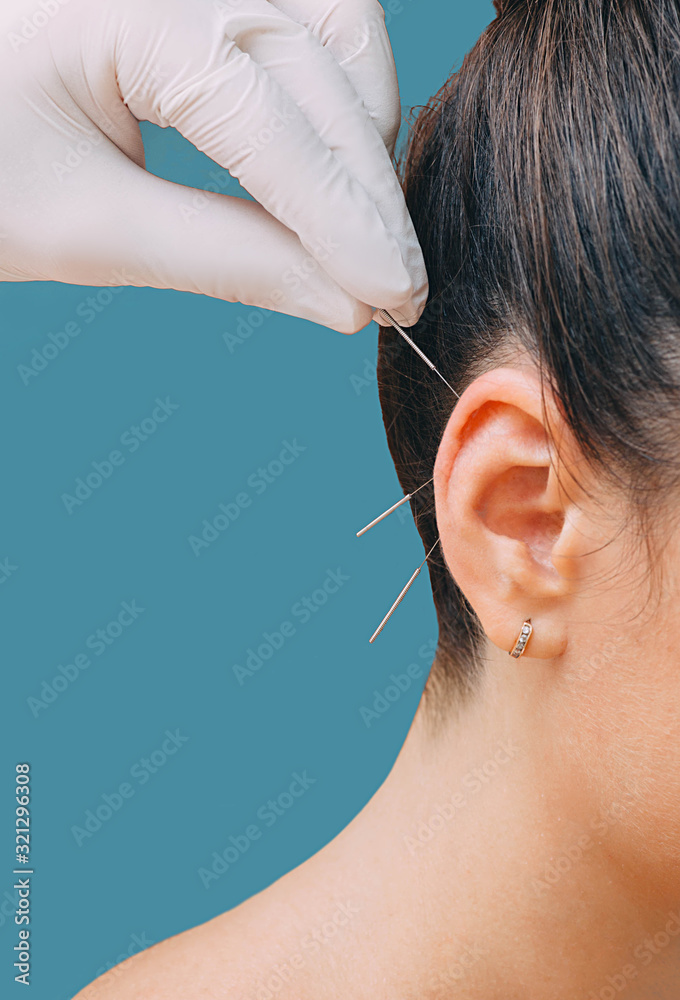 Hand of a reflexologist with an acupuncture needle near a woman's ear. Treatment of many diseases by ear acupuncture. Needles close-up on a blue background - obrazy, fototapety, plakaty 