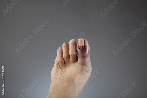 Broken Toe on left foot