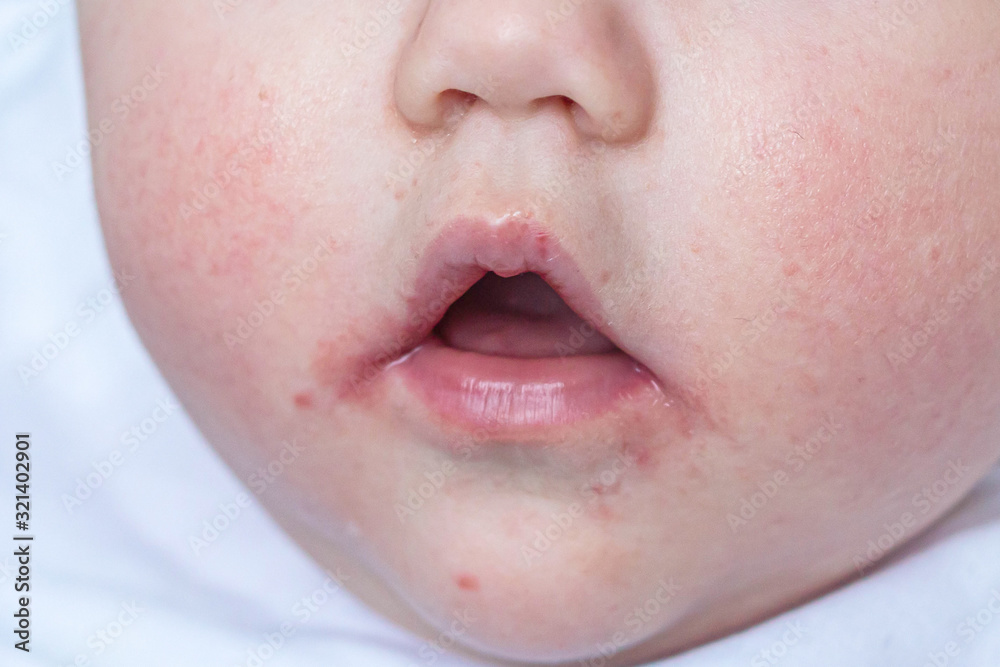 Atopic Dermatitis. Skin rash on baby face. Allergy concept. Stock Photo
