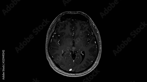 Human brain MRI scan, Gradient echo axial T1, infused Gadolinium, Imaging at 3T. Real brain scan. photo