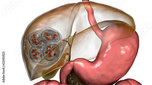 Structure of hydatid cyst of Echinococcus multilocularis, 3D illustration. E. multilocularis is a parasitic worm that causes alveolar echinococcosis with production of cysts in liver and other organs photo