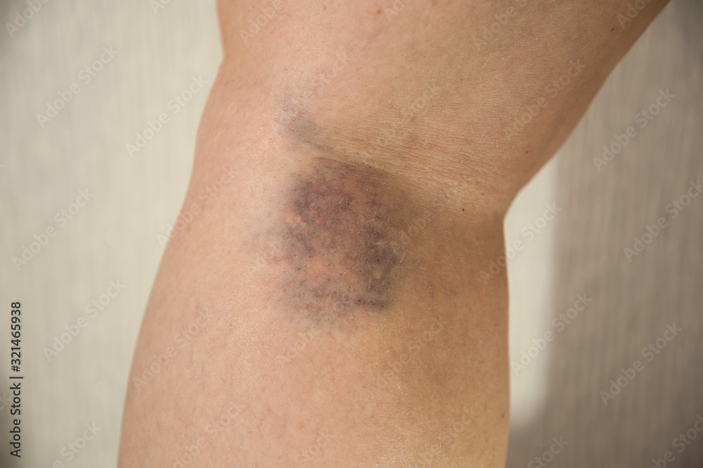 Dark blue, black bruise on the back of the female leg as a result of a ruptured vessel. A vein burst on the leg. Tissue injury Dark blue, black bruise on the back of the female leg as a result of a ruptured vessel. A vein burst on the leg. Tissue injury