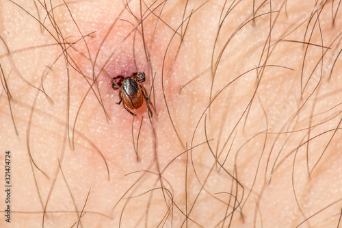 Slika na platnu biteblack legged tick, closeup, danger, deer tick, disease, embedded tick, healt
