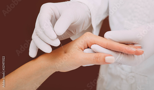 Woman body treatment acupuncture hand. Alternative oriental medicine