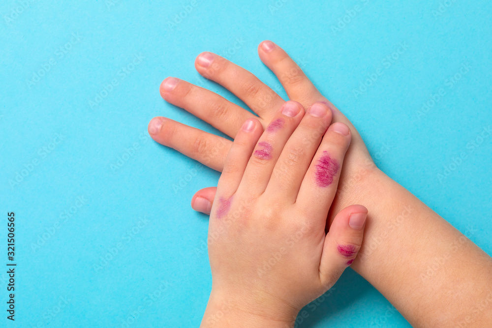 children hand with dermatitis. eczema on hand. Isolated on the blue background children hand with dermatitis. eczema on hand. Isolated on the blue background