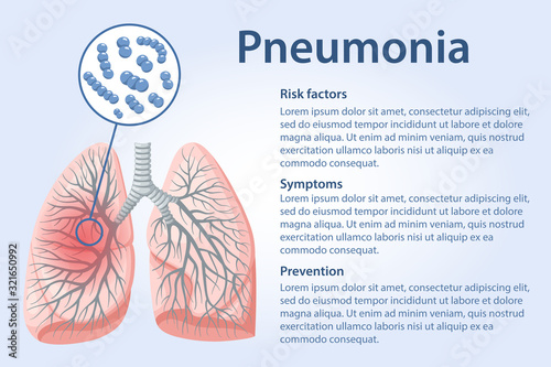 Page template with image of Streptococcus pneumoniae bacteria infected lungs, text on Pneumoniae symptoms, risk of disease and preventive measures. Vector illustration in flat style.