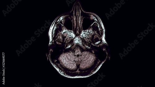 Voluminous color MRI scans of the brain and head to detect tumors. Diagnostic medical tool