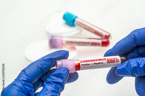 Coronavirus blood test . 2019-nCoV Coronavirus originating in Wuhan, China