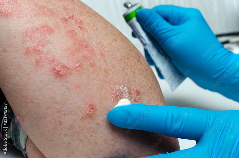 Treatment of psoriasis. A gloved doctor applies a medicated ointment to