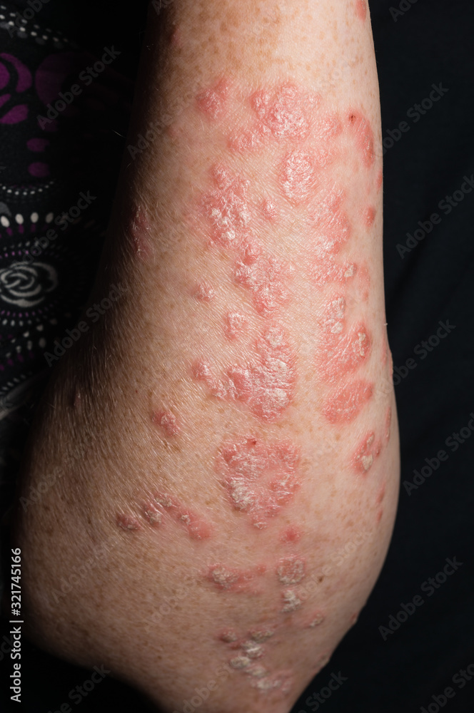 Inflamed psoriatic plaques on the white skin of the woman's forearm on a black background. Inflamed psoriatic plaques on the white skin of the woman's forearm on a black background.