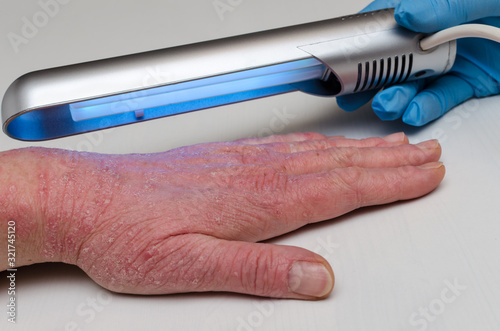 Bild auf Leinwand Treatment of skin diseases with narrow-band ultraviolet with a wavelength of 311 nm