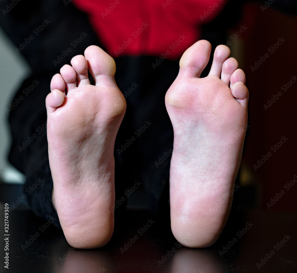 Fototapeta premium hallux valgus