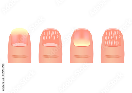 Onychomycosis or tinea unguium vector / nail disease / finger photo