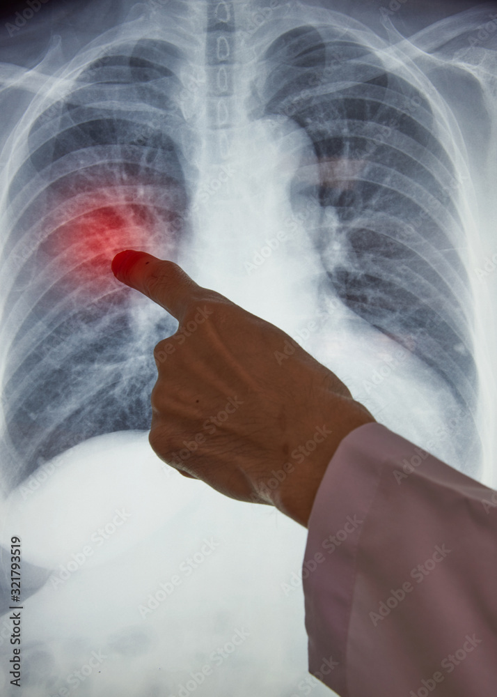 Doctor hand pointing at chest x-ray in computer monitor