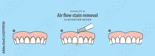 Air flow stain removal and teeth cleaning step (upper) illustration vector on blue background. Dental concept.
