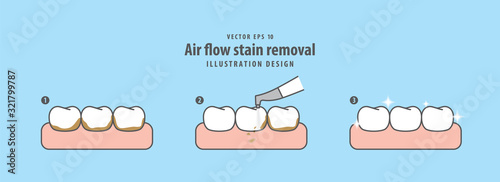 Air flow stain removal and teeth cleaning step illustration vector on blue background. Dental concept.