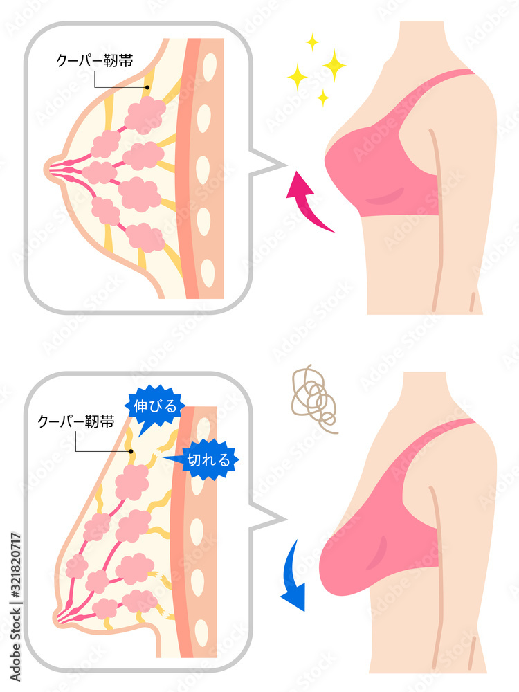 きれいな胸と垂れた胸 女性の上半身 Stock Vector Adobe Stock
