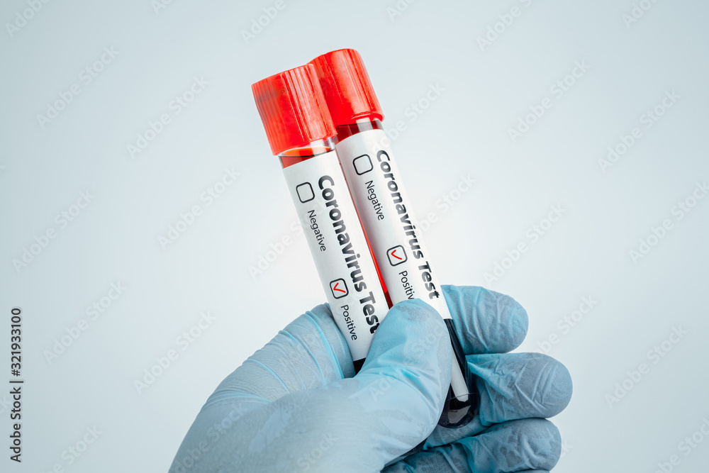 Obraz premium Scientist holding blood samples in test tubes with positive diagnosis result marked. Epidemic Mers-CoV Coronavirus researching and treatment concept.