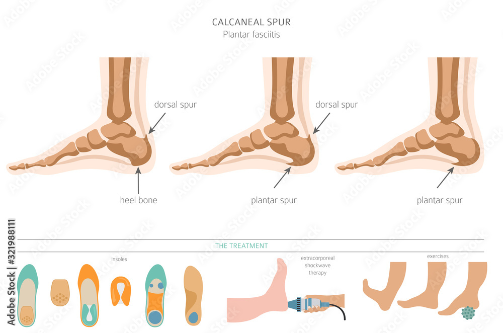 Calcaneal spur. Plantar fasciitis set. Medical desease infographics ...