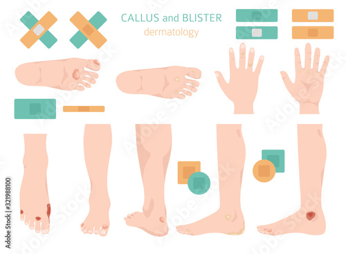 Callus, corn and blister feet and hands. Dermatology. Medical desease infographics collection