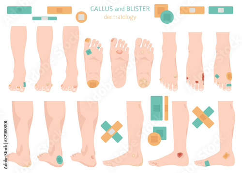 Callus, corn and blister feet and hands. Dermatology. Medical desease infographics collection