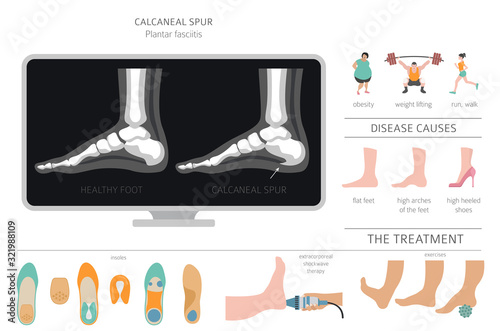 Calcaneal spur. Plantar fasciitis set. Medical desease infographics collection