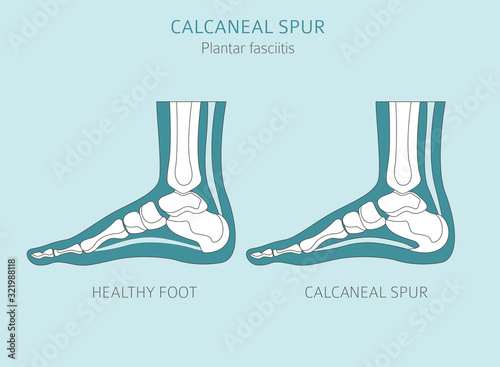 Calcaneal spur. Plantar fasciitis set. Medical desease infographics collection