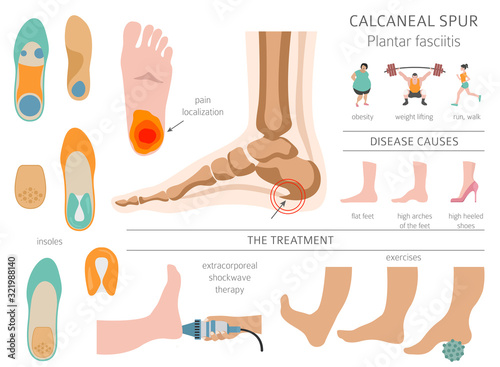 Calcaneal spur. Plantar fasciitis set. Medical desease infographics collection