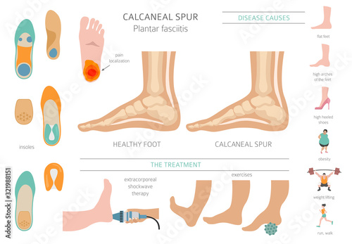 Calcaneal spur. Plantar fasciitis set. Medical desease infographics collection