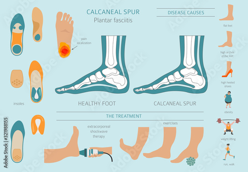 Calcaneal spur. Plantar fasciitis set. Medical desease infographics collection