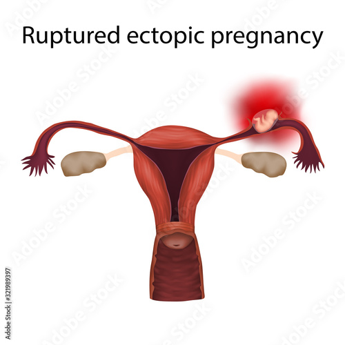 Ruptured ectopic pregnancy. Growing fetus ruptures fallopian tube. Medical anatomy illustration. photo