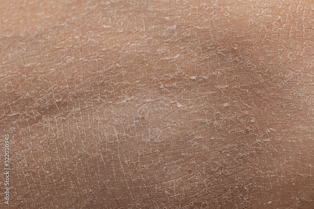 Fototapeta premium Very dry skin with evident exfoliation, extreme close up of dehydrated human skin