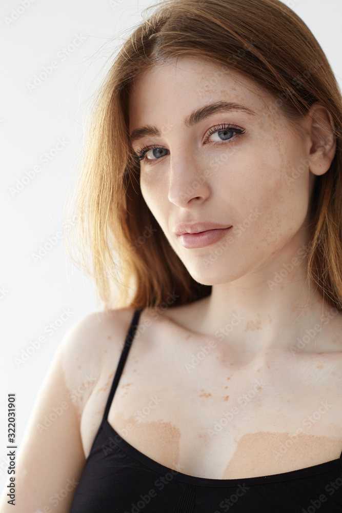 Vertical shot of beautiful gorgeous female model with loose hair and sensual lips having vitiligo affected skin with white patches on her chest, dressed in black tank top, looking at camera Vertical shot of beautiful gorgeous female model with loose hair and sensual lips having vitiligo affected skin with white patches on her chest, dressed in black tank top, looking at camera