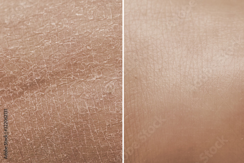 Skin before and after a treatment with moisturizing cream. Concept of anti-aging products