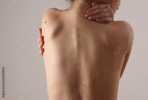 Papier peint Checking benign moles : Woman with birthmarks on her back