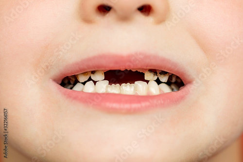 Kid patient open mouth showing cavities teeth decay. Close up of unhealthy baby teeth. Dental medicine and healthcare - human patient open mouth showing caries teeth decay