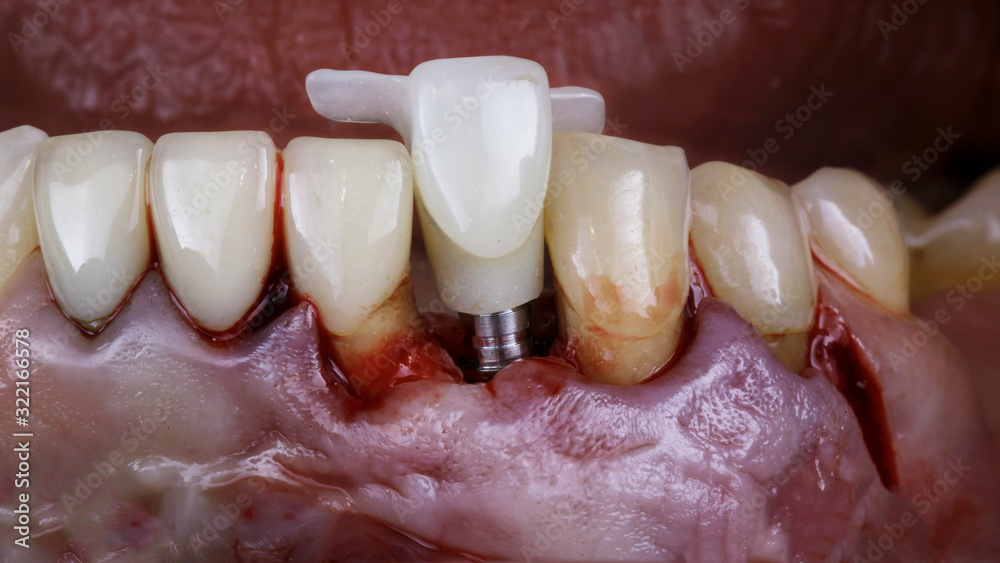insertion of a crown after implantation in the lower jaw insertion of a crown after implantation in the lower jaw