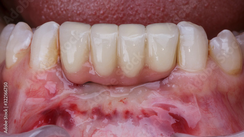 small denture on the lower jaw after implantation