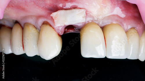 gum and flap for gum volume and crown placement