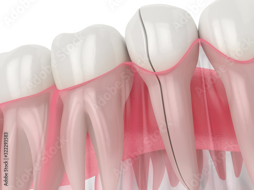 Картината върху платно 3d render of jaw with split tooth