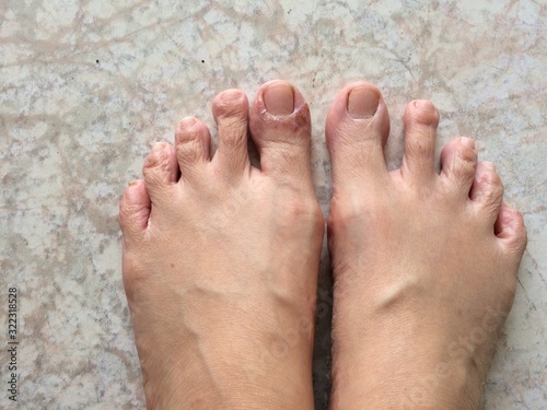 Peeling skin, rash on the feet, must be treated with medicine. © Nuan