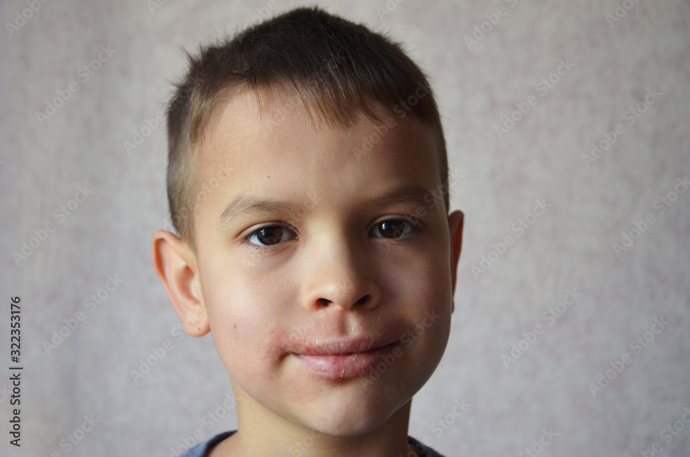 close up lips and face of a schoolboy or teenager with allergies. Lip irritation. Portrait of smiling child sneezing, scratching nose, seasonal allergy, modern illness close up lips and face of a schoolboy or teenager with allergies. Lip irritation. Portrait of smiling child sneezing, scratching nose, seasonal allergy, modern illness