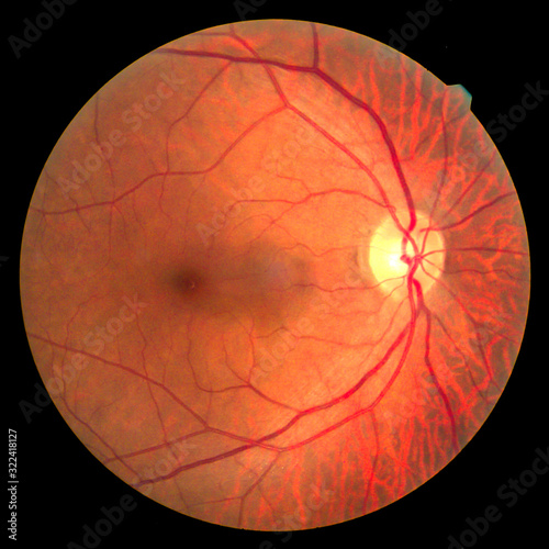 View inside human eye disorders - showing retina, optic nerve and macula.Medical photo tractional retinal detachment of diabetes.Eye treatment concept.select focus.