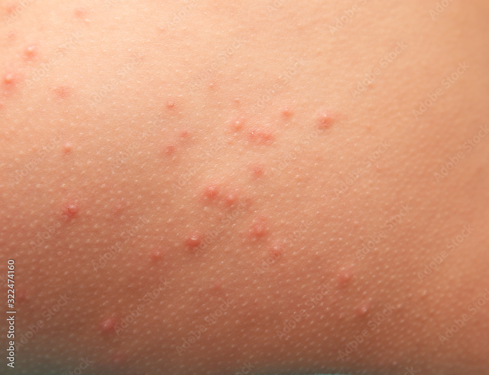 allergic rash on children's skin