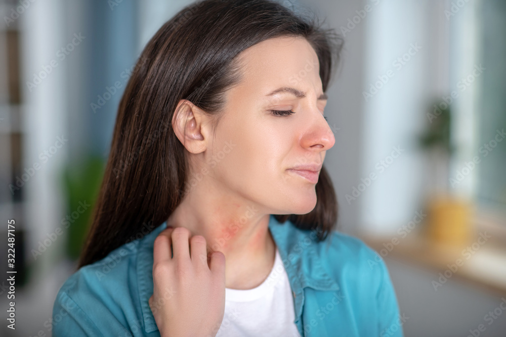 Allergic woman having red spots on her neck Allergic woman having red spots on her neck