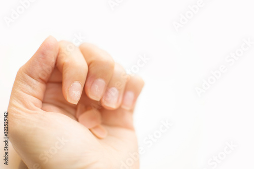 Close up woman nails after bad manicure on white background. Overgrown cuticle fingernails and tainted nail plate. Blurred. Grew nails. Gel nail polish fell off. Copy space. Healthy and care concept