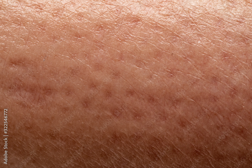 Fototapeta premium Orange peel on female leg skin close up, cellulite caused by water retention