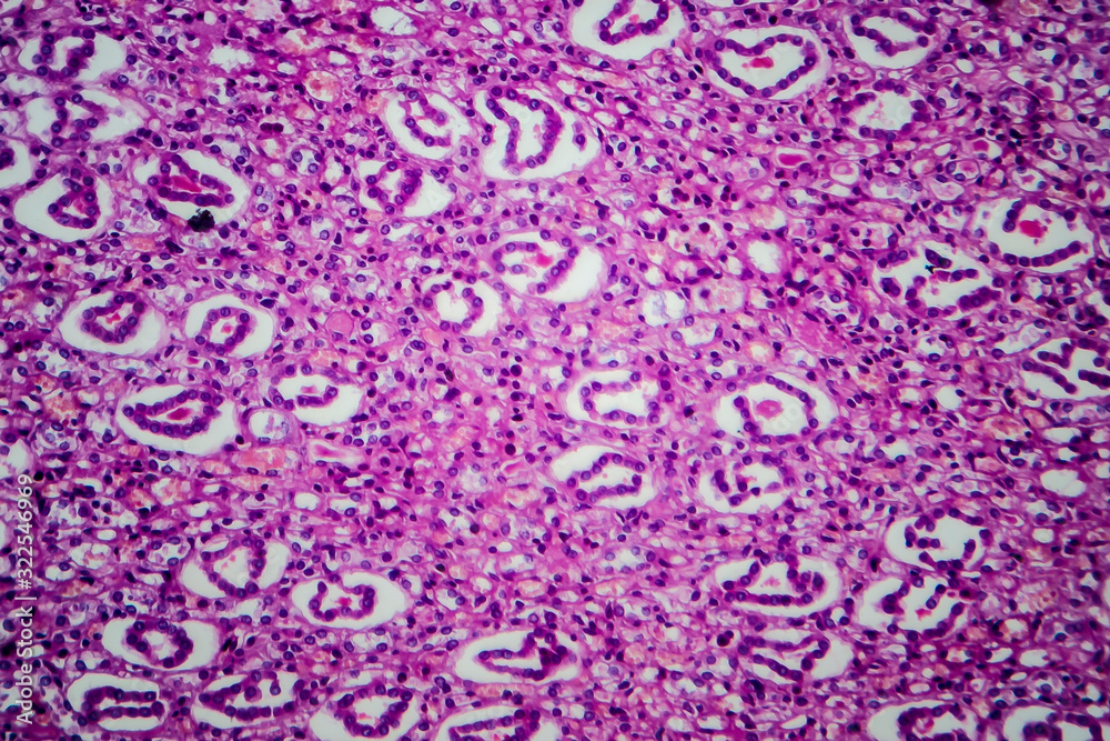 Acute pyelonephritis, light micrograph Acute pyelonephritis, light micrograph